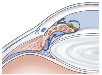 Narrow-angle glaucoma; resistance of flow through the pupil