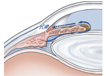 Wide-angle glaucoma; blockage of aqueous humor at the trabecular meshwork