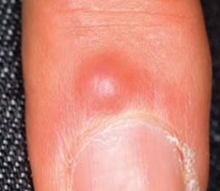 Digital mucous cyst