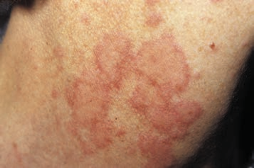 A café-au-lait macule