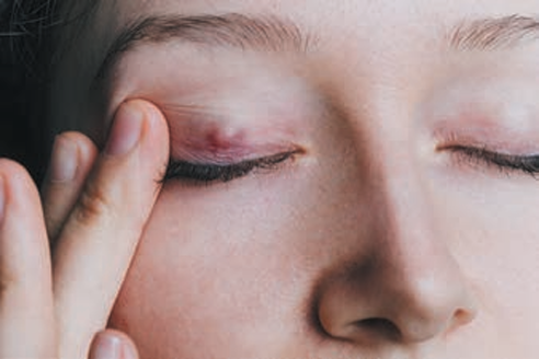 Chalazion (Nodule)