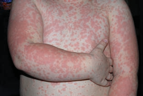 Papular drug eruption