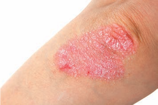 Psoriasis (Plaque)