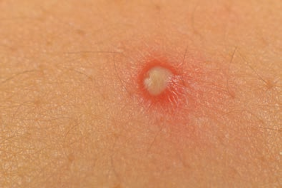 Acne pimple (Pustule)