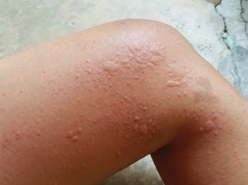 Allergic wheals, urticaria