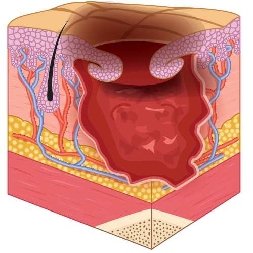 Stage 3 with Epibole