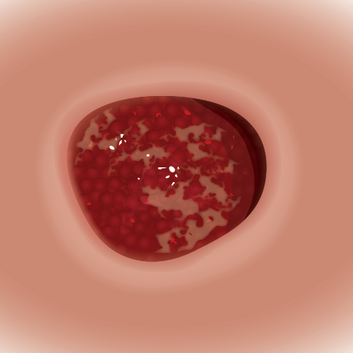 Stage 3 with Epibole