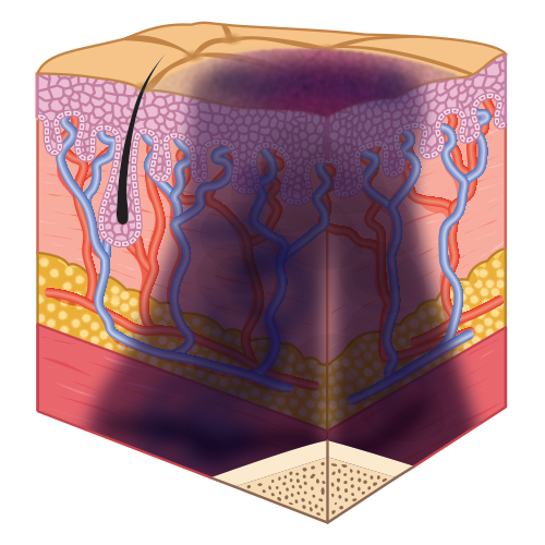 Deep tissue pressure injury