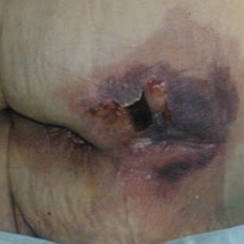Deep tissue pressure injury