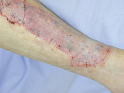 Split-thickness Sheet Graft